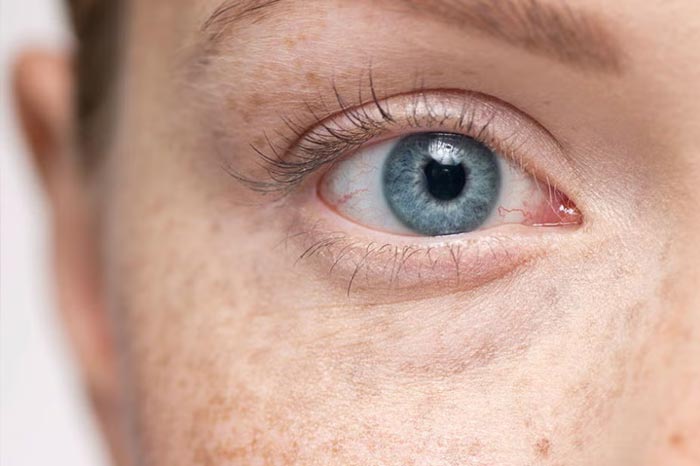 주근깨 - Freckles