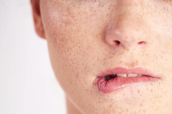 선천성 반점인가요? 양측성 모반양 반점 진단 가이드