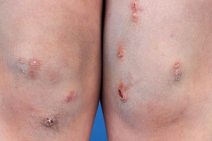 결절성 양진이 반복될 때, 피부과 전문의의 진단이 중요한 이유