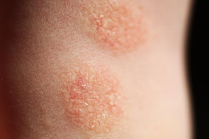 화폐상 습진이란? 원인, 증상, 회복을 위한 관리