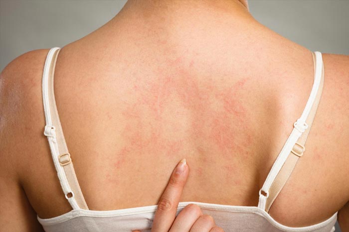 갑작스러운 발진, 두드러기 원인과 대응법